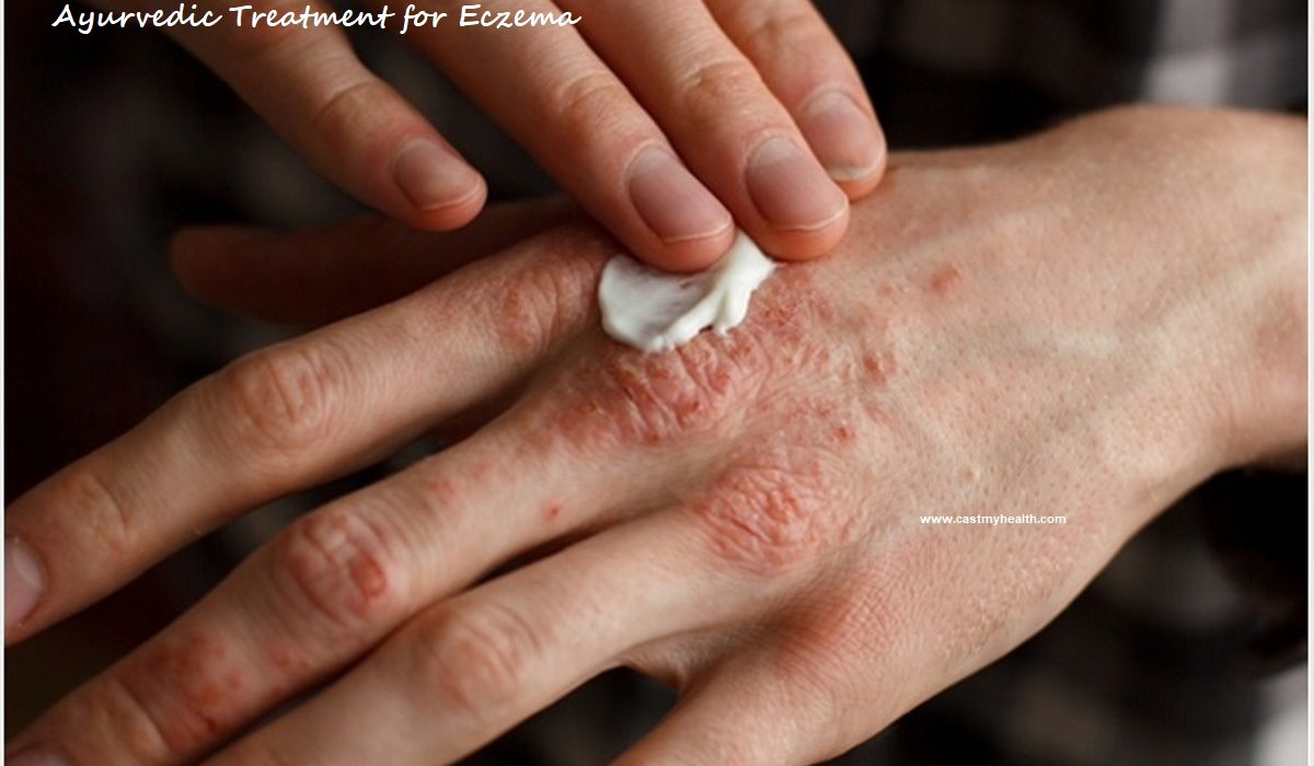 Ayurvedic Treatment for Eczema