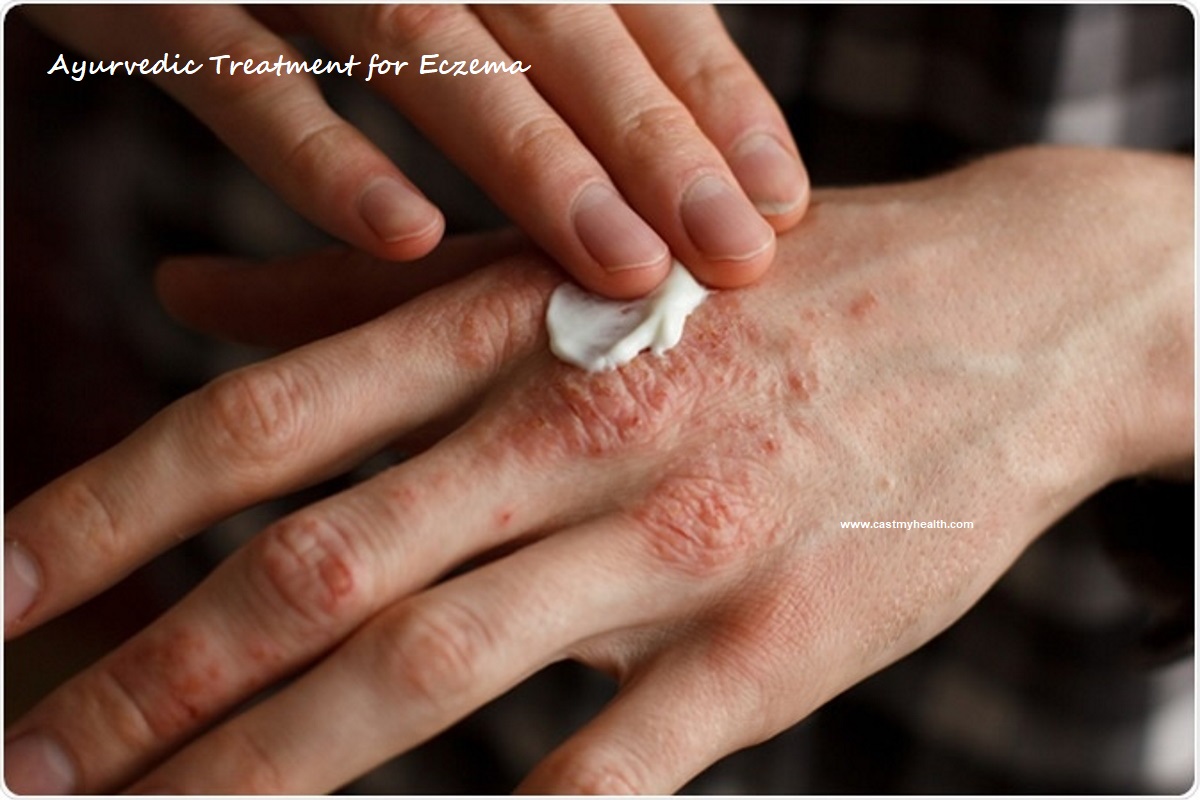 Ayurvedic Treatment for Eczema