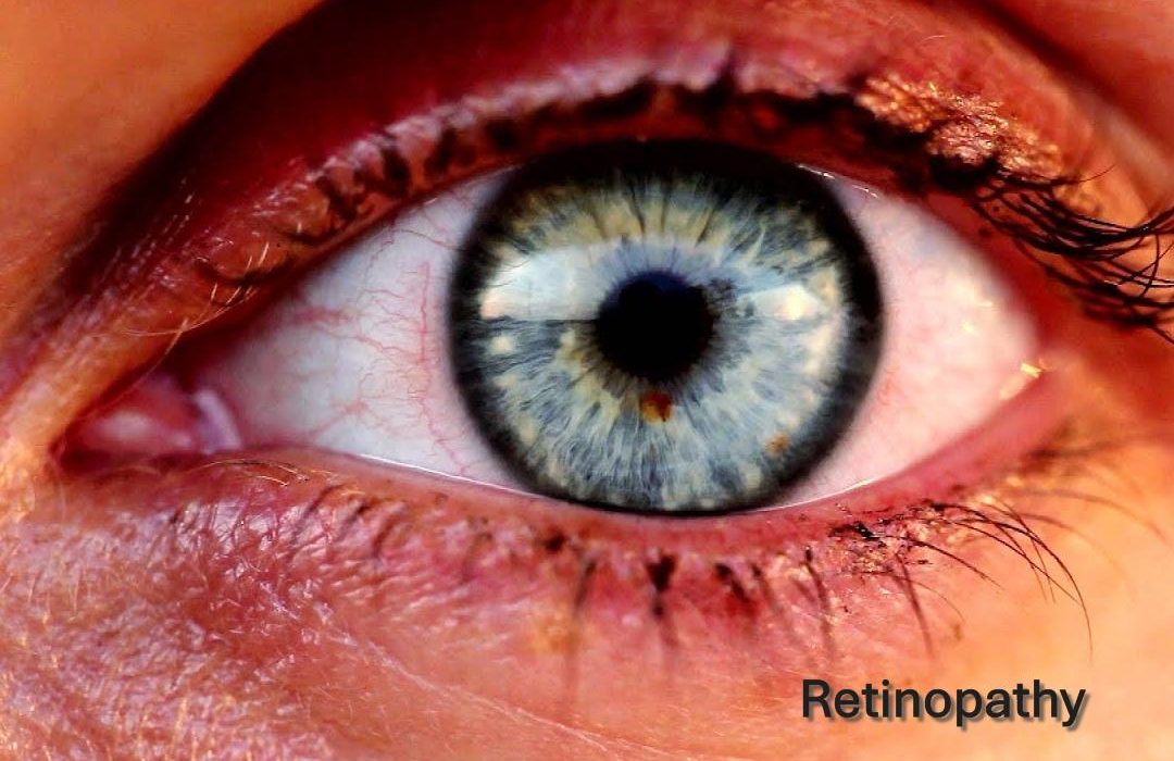 Solar Retinopathy